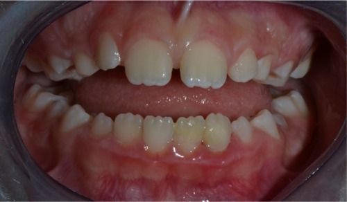 Figure 7 Frontal view of teeth after 8 month recall.