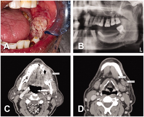 Figure 1. A 62-year-old Indian male with a cT4aN1M0 intraoral lesion. (A) Exophytic ulcerative squamous cell carcinoma of the left buccal mucosa. (B) Left side of panoramic dental x-ray demonstrating absence of bony invasion. This finding was corroborated by CT scan. (C–D) CT neck revealed a 2.3 × 1.9 × 2.3 cm tumor at the left buccal mucosa and a 2.3 × 1.3 cm centrally necrotic ipsilateral lymph node at level 1B.