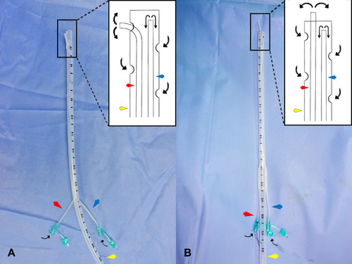 Figure 1 The structure of the MIVD device (red arrows, the external irrigation tube; blue arrows, the internal irrigation tube; yellow arrows, the drainage tube; black arrows, external irrigation fluid flow; dotted black arrows, internal irrigation fluid flow). (A) The external irrigation tube stretched out from one of the side holes on the drainage tube wall. (B) The external irrigation tube stretched out from the free end of the drainage tube.