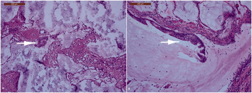 Figure 2. The pleura is transformed into a fibrous tissue containing irregular mucinous pools. These may contain slightly atypical cilindrical epithelium (white arrow), either free-floating in the mucin (A) or still attached to the fibrous wall of the pool (B).