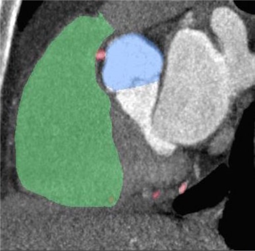 Figure 4 CCTA showing the right coronary artery taking a posterior inter-arterial course between the aorta and pulmonary trunk.