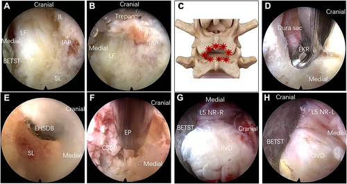 Figure 4 Key steps of decompression and discectomy process. (A) The structures of original point. (B) Laminoplasty with the full-visualized trepan. (C) Laminoplasty in this order. The contralateral decompression with an endoscopic (D) Kerrison rongeur or (E) high-speed diamond bur or (F) piezosurgery. Exposure of (G) ipsilateral and (H) contralateral herniated disc.