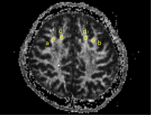 Figure 1 Oval regions of interest (ROIs) of identical size (20 mm2) were used to measure fractional anisotropy (FA) values. The same ROI was used for both measures, and all ROIs were placed on axial slices. Bilateral superior gyri and middle frontal gyri ROIs were placed halfway between the precentral sulcus and anterior boundary of the brain, on the most inferior slice where both gyri were visible as separate structures. a: the right middle frontal gyrus, b: the left middle frontal gyrus, c: the right superior frontal gyrus, d: the left superior frontal gyrus.