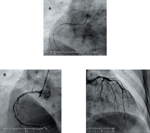 Figure 2 Panel A: successful passage of the wire, while the balloon is inserted over another wire at the place where it stopped. Panel B and C: Final angiographic result on RCA (B) and LAD (C).