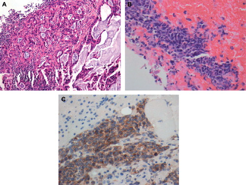 Figure 1. A. Lung biopsy showing adenocarcinoma. Hematoxylin and eosin stain; B. Pleural biopsy showing SCLC. Hematoxylin and eosin stain; C. Synaptophysin staining of the pleural biopsy specimen.