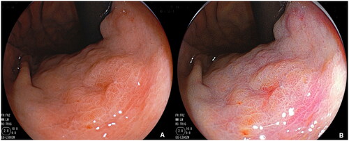 Figure 3. Representative endoscopic images of early gastric cancer (EGC) by using WLI(A) and LCI(B).