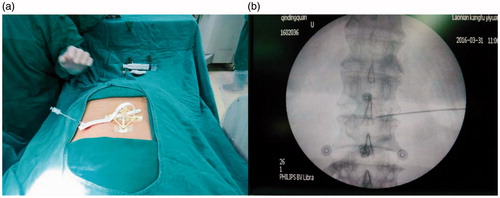 Figure 6. Clinical check under X-ray guidance. (a) Attachment of the board. (b) The five electrode patches (concentric circles) and the puncture results.