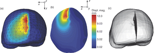 Figure 7. Deformation of the biomechanical model based on XFEM for retraction modeling. (a) External surface mesh of the biomechanical model with color levels corresponding to the magnitude of the displacement field. (b) Slice of the biomechanical model with same color coding. (c) Final mesh resulting from the modeling of the retraction using XFEM. The tetrahedra that were added to display the opening of the cut lips are there only for visualization purposes. The edges of FEs cut by the discontinuity have actually been made discontinuous and their nodes moved apart.