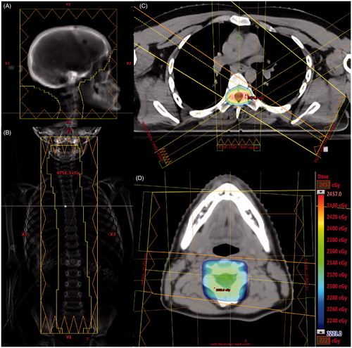 Figure 2. (A) Right lateral cranial field. (B) Single straight posterior spine field. (C) Axial image of dose from three spine fields (one straight posterior and two obliques). (D) Axial image of dose at cranial fields and posterior upper spine field overlap region. The dose color wash legend displays dose from 95% to 105% of 23.4 Gy. The legend is applicable to C and D.