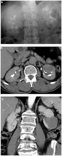 Figure 5 Left renal tumor. (A) Intravenous urography show a filling defect at the left lower calyx. (B and C) Axial and coronal contrast enhanced computed tomography shows a renal parenchymal tumor infiltrating the calyces.