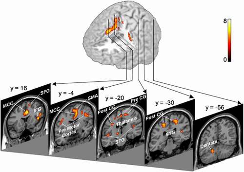 Figure 2. Thermal comfort activations included the midcingulate cortex (MCC) (y = 16 and −4), inferior frontal gyrus (IFG) (y =16), superior frontal gyrus (SFG) (y = 16), supplementary motor area (SMA) (y = −4), premotor cortices (y = −4), primary somatosensory (Post CG) (y = −20 and −30), and motor cortices (Pre CG) (y =−20), thalamus (y = −20), bilateral superior temporal gyri (STG) (y = −20 and −30) and dentate nucleus of the cerebellum [y = −56). y – Distance from anterior commissure in mm. Positive values are anterior, and negative values are posterior to the anterior commissure. Adapted from “Brain activation associated with ratings of the hedonic component of thermal sensation during whole-body warming and cooling.” By [Citation64]