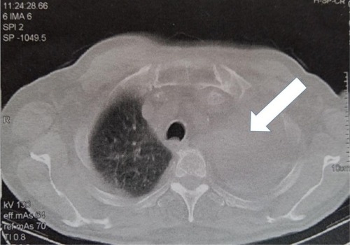 Figure 2 Computed tomography scan of the thorax (during abraxane); the left lung is totally collapsed (white arrow).