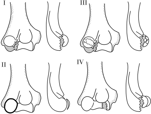 Figure 2 Illustration of the Bryan and Morrey classification for capitellum fractures with the McKee modification. I: Large osseous capitellum piece, II: Shear fracture of the articular cartilage, III: Comminuted fracture of the capitellum, IV: McKee modification that includes a coronal shear of the capitellum and trochlea.