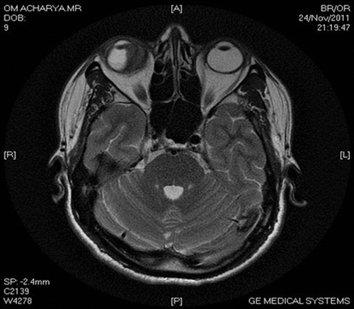 FIGURE 3  Axial section MRI showing diffuse enhancing lesion nasal to the right globe.