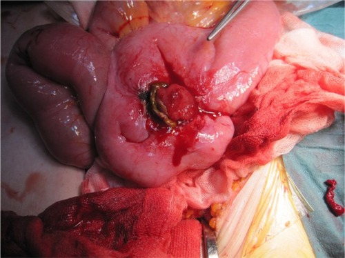 Figure 2 Operative findings of a perineal fistula from the distal ileum.