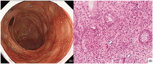 Figure 1. Colonoscopy findings. (A) Colonoscopy revealed inflammatory mucosal lesions, including fine erosions, multiple shallow small ulcers, and map-like redness from the caecum to the splenic flexure at the onset of colitis. (B) Biopsy specimen of the colonic mucosa is notable for a dense inflammatory infiltrate including many eosinophils and several foreign body type of giant cells (at the arrows; original magnification ×132. Electronic camera lens magnification is ×3.3. Microscope objective lens magnification is ×40).