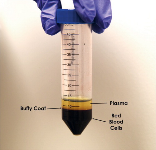 Figure 1. Preparation of PRP. Following 1–2 spin cycles, three distinct layers can be identified: red blood cells at the bottom, buffy coat containing white blood cells and platelets in the middle, and plasma on top. The buffy coat is removed with a pipette and the plasma is isolated.