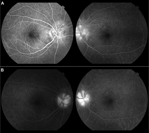 Figure 3 Fluorescein angiography at early phase (A) and late phase (B) in 2012. Fluorescein angiography showed strong staining and weak late phase leakage from the optic disc in both eyes. There were no dilated superficial capillaries on optic discs.