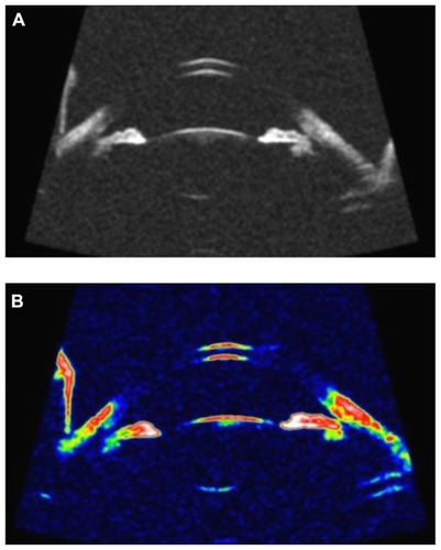 Figure 2 The image was obtained for the same subject but with UBM for ACA and ACD. A black and white, and B in color.