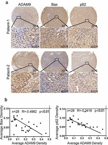 Figure 4. Correlation between ADAM9 expression and BAX and p62 expression in HCC tissues after radiotherapy. (a) Immunohistochemical staining was conducted for determining the association of ADAM9 expression with autophagy-related P62 and Bax protein expression within human HCC samples. (b) Results of multiple linear regression analysis of ADAM9 expression and BAX and P62 expression. Data were displayed in a form of mean ± SD from 3 independent assays conducted in triplicate.*p < 0.05,**p < 0.01, and***p < 0.001