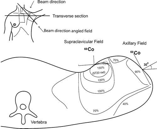 Figure 2.  A typical dose distribution chart (isodoses) through the centre of the axilla and supraclavicular fields. The patient is viewed from below; the picture displays the left axilla (this is also the way a routine CAT-scan is displayed). Note the 30% overdose compared to the prescribed dose. The icon in the upper left corner shows the patient from the front, with the angled irradiation field indicated. The left breast is missing.