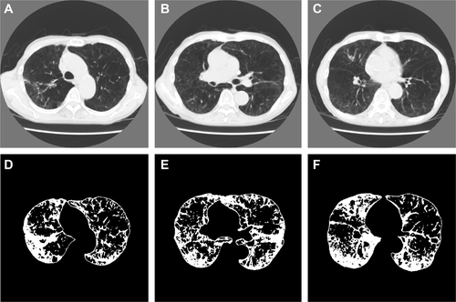 Figure S4 Representative computed tomography (CT) images and results of preprocessing of the upper, middle, and lower lung fields in a 75-year-old man with COPD.Notes: Forced expiratory volume in 1 second (FEV1)/forced vital capacity; FEV1; b0, b1, R; and the percentage of low-attenuation lung area were 28.1%; 27.5%; 977, 443, 0.453; and 56.6%, respectively (b0, the zero-dimensional Betti number; b1, the one-dimensional Betti number; R, b1/b0). The CT images and the binarized images are shown in (A–C) and (D–F), respectively.