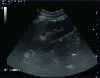 Figure 1. Ultrasonographic image of the right kidney. Note the decreased corticomedullary junction.