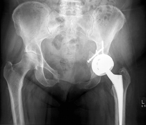 Figure 7. Postoperative radiograph showing pelvic resection, total hip arthroplasty, and bone block fixed to anterior column.
