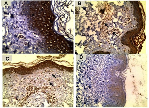 Figure 1 (A) A skin tag section showing strong IGF-1 expression in epidermis (immunoperoxidase ⨰400). (B) A skin tag section showing moderate expression of IGF-1 in epidermis and dermal endothelial cells (arrows) with its strong expression in dermal inflammatory cells (immunoperoxidase ⨰200). (C) A skin tag section showing moderate expression of IGF-1 in epidermis with its strong expression in dermal fibroblasts (arrows) and inflammatory cells (immunoperoxidase ⨰200). (D) Normal skin section showing mild expression of IGF1 in epidermis and negative expression in dermis(endothelial cells, fibroblasts and inflammatory cells) (immunoperoxidase ⨰200).