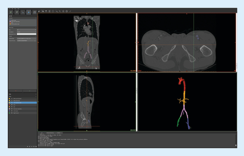 Figure 1. CT data segmentation using Mimics InPrint 2.0.Color-coded segments (bottom right) were virtually cut to fit our printer's build volume.