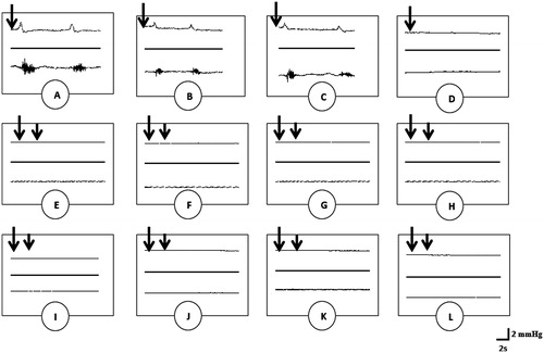 Figure 2. Polygraphic intraseminal pressure (upper) and EMG (lower) tracings showing the effects of dopamine (0.1 μmol/kg) (A), aqueous extract (B) and methanol extract (C) of G. tessmannii (20 mg/kg), haloperidol (0.26 μmol/kg) plus aqueous extract of G. tessmannii (20 mg/kg) (D), sulpiride (0.26 μmol/kg) plus aqueous extract of G. tessmannii (20 mg/kg) (E), Sch23390 (0.26 μmol/kg) plus aqueous extract of G. tessmannii (20 mg/kg) (F), haloperidol (0.26 μmol/kg) plus methanol extract of G. tessmannii (20 mg/kg) (G), sulpiride (0.26 μmol/kg) plus methanol extract of G. tessmannii (20 mg/kg) (H), Sch23390 (0.26 μmol/kg) plus methanol extract of G. tessmannii (20 mg/kg) (I), haloperidol (0.26 μmol/kg) plus dopamine (0.1 μmol/kg) (J), sulpiride (0.26 μmol/kg) plus dopamine (0.1 μmol/kg) (K), Sch23390 (0.26 μmol/kg) plus dopamine (0.1 μmol/kg) (L) on the bulbospongiosus muscles and seminal vesicles, respectively. Long and short arrows indicate the first and second injections, respectively.