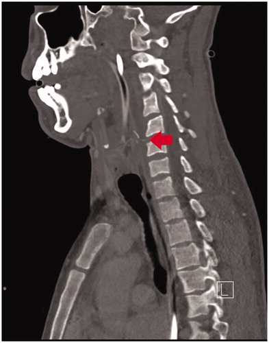 Figure 3. Sagittal CT slice shows a residual foreign body (arrow) at the posterior wall of hypopharynx.