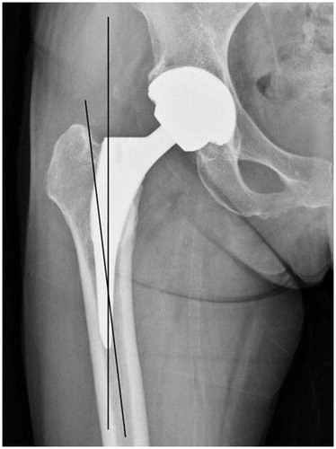 Figure 4. Anteroposterior radiograph of the right hip after manual rasping THA shows a stem alignment in 7.9° of varus.