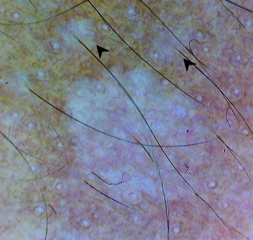 Figure 5 Dermoscopy (original magnification 10×) showing radial distribution of the lesion from hair follicle and satellite lesions (black arrowhead).