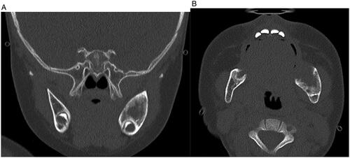 Figure 3. (A and B) Coronal and Axial CT imaging in the bone window demonstrate bony destruction at the medial aspect of the lesion without violation of the cortex at the time of diagnosis.