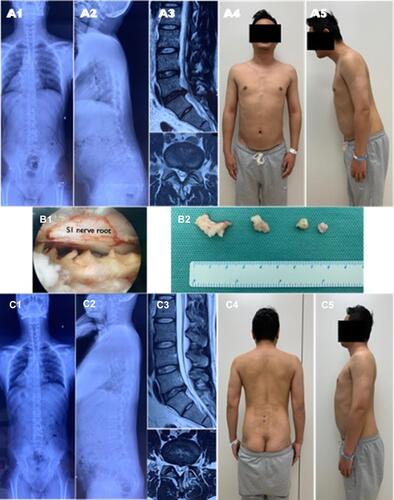 Figure 4 A 30-year-old male LDH patient with right leg sciatica present spinal sagittal imbalance (A1-2). L5/S1 left side disc herniation was shown in MRI (A3). X-ray (A1-2) and physical appearance (A4-5) showed the trunk shifted to forward in sagittal plane. UBED surgery was performed (B1-B2) and postoperative MRI showed herniated disc was removed (C3). X-ray (C1-2) and physical appearance (C4-5) showed sagittal imbalance acquired recovery immediately after surgery.