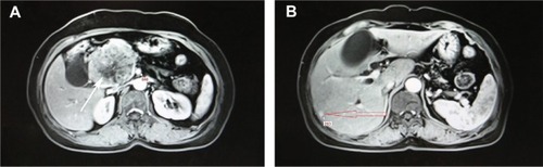 Figure 1 Abdominal enhanced magnetic resonance imaging with T1 findings.