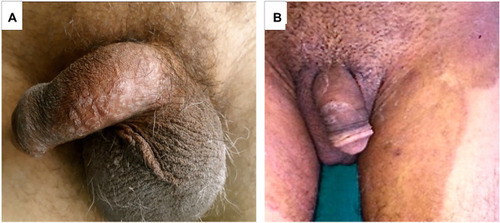 Figure 1 Genital dermatophytosis in males. (A) Solitary scaly plaques over penile shaft with no involvement of groin. (B) Hyper-pigmented extensive tinea cruris. Annular scaly plaques over penile shaft with no central clearing.