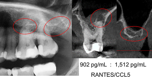 Figure 2 Left window shows OPG with teeth 25, 26, 27 and alveolar area 28 up to and including retromolar area 29. Apical area of 26 and areas 28/29 are marked with red circles and radiographically largely inconspicuous. Centre image shows frontal section CBCT/DVT at 26 with clear AP at palatal root. Right window shows radiographic image in frontal section CBCT/DVT at 28/29 with clear resolution of the cancellous bone structure. Picture below centre and right radiographic image displays the results of R/C expression in AP 26 and in BMDJ/FDOJ 28/29 for comparison. Figure Indicators: Red circles mark inflammatory areas of alveolar bone.