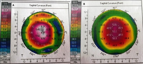 Figure 1 Corneal topographic curvature map of the right (A) and (B) left eyes.