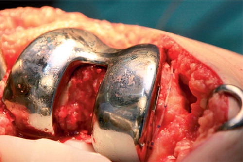 Figure 1. Pain catheter placement in total knee replacement. The catheter is led along the medial femoral condyle, usually on raw bone, medial to the metal femoral component. Using artery forceps, it is then passed posterior to the medial femoral condyle so that the tip lies in front of the posterior capsule.