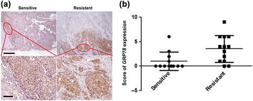 Figure 4. Differential expression of GRP78 in human TACE-sensitive or resistant HCC. (a) Weak staining of GRP78 in tumor cells of TACE-sensitive HCC and strong positivity in tumor cells of TACE-resistant HCC (Upper panel, Bar = 20 um; lower panel, bar = 100 um). (b) Scoring of GRP78 staining. The scoring was calculated based on both staining intensity and area of positivity.