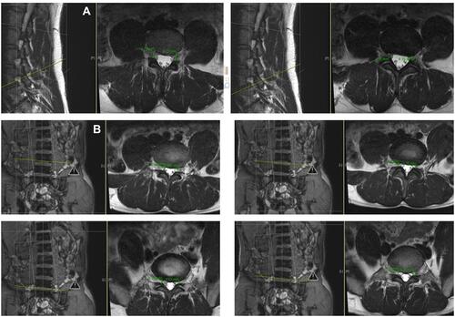 Figure 12 (A) Measurements of NF at and below the spinal nerve with parallel endplate (PE) slices. (B) Axial S-PE with measurements demonstrating NF caliber at and below the spinal nerve with parallel endplate (PE) slices.