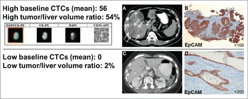 Figure 3. Computer tomography (CT), CTC images and EpCAM immunostaining of CRC tumors. EpCAM is consistently expressed in CRC primary tumors, also in patients that have no CTCs detectable by EpCAM-based CellSearch® system. Shown are: mean CTC numbers (±SEM), the actual liver/tumor volume ratio, a CTC (CellSearch® system qualifies a cell as a CTC if it has an evident nucleus by DAPI and if it is EpCAM+, cytokeratin 8/18/19+, and CD45-), (A) CT scan of a patient with a high tumor/liver ratio (≥30%) and high baseline CTCs (≥3), (B) EpCAM immunostaining with a monoclonal antibody (BerEP4) and peroxidase method of the respective CRC primary tumor, (C) CT scan of a patient with a low high tumor/liver ratio (<30%) zero baseline CTCs, and (D) EpCAM immunostaining of the respective CRC primary tumor.