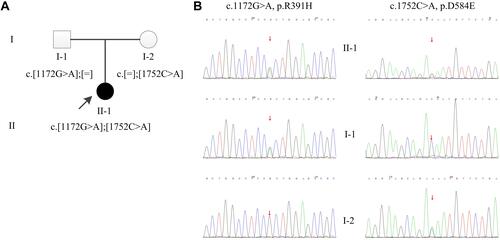 Figure 1 Pedigree and sequence analysis of the Chinese family. (A) Pedigree of the Chinese family. The filled circle indicates affected individual, and the open circle and box indicate non-affected individuals. The proband is indicated by an arrow. (B) Sanger sequencing confirmation of the Chinese family. The proband (II-1) carried compound heterozygous mutations: c.1172G>A inherited from his father (I-1) and c.1752C>A from his mother (I-2). Square: Male; Circle: Female.