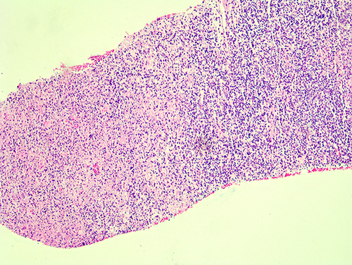 Figure 3 Pathological image of lymph node (4X).