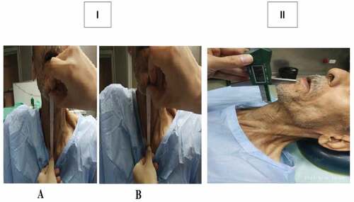Figure 1. Photo I is the sternomental displacement measurement: A at extension and B at neutral position. Photo II is the thyromental height test measurement using a digital depth gauge. Our team captured the photo after the patient’s consent.