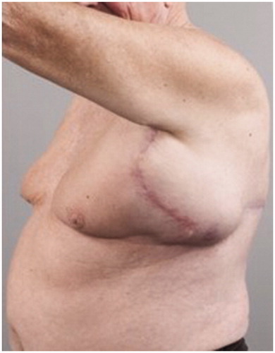 Figure 2. Preoperative left lateral view of the patient showing the presence of the large left axillary encapsulated seroma.