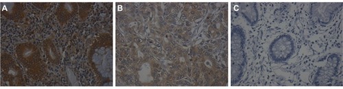 Figure 1 The expression of eIF3d in gastric cancer tissues and adjacent noncancerous tissues.