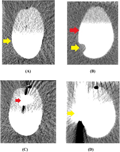 Figure 4. CT imaging of the MWA procedure. (A) The cyst mimic model showed a regular morphology with clear borders after contrast injection into the cystic cavity (yellow arrow). (B) The cystic neoplasm mimic model showed a regular morphology with clear borders (red arrow). The filling defect of the VX2-implanted tumor (yellow arrow) was visible in the cystic cavity after contrast injection. (C) A 17 G microwave antenna (red arrow) was inserted along the length of the cystic neoplasm mimic model, perpendicular to the level of the agarose gel fixation base. (D) The system thermometer (yellow arrow) was placed at the outer edge of the bladder wall to monitor temperature changes.